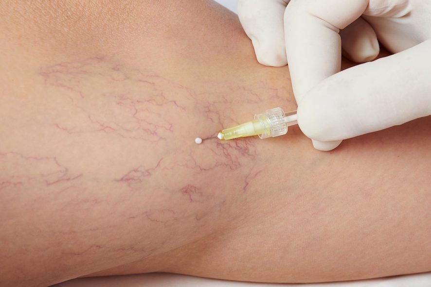 Tratamiento de varices con Microespuma: En qué consiste